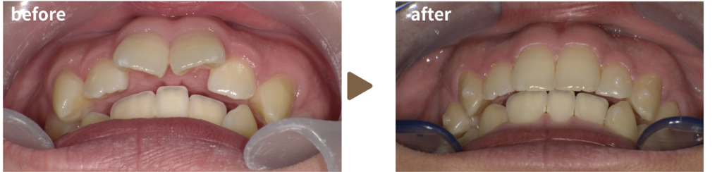 マウスピース治療を受けた30代男性の治療前後の写真