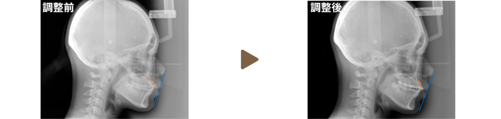 ワイヤー矯正を行った10代女性の調整前後のレントゲン写真