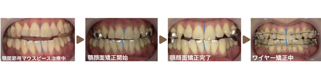 矯正治療を受けた30代男性の治療経過の写真