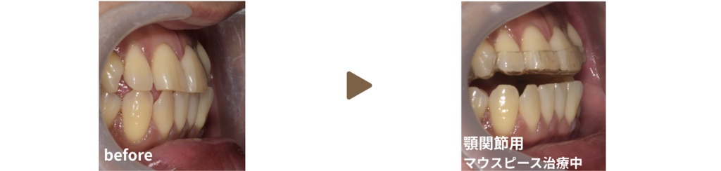 矯正治療を受けた30代男性の治療経過の写真