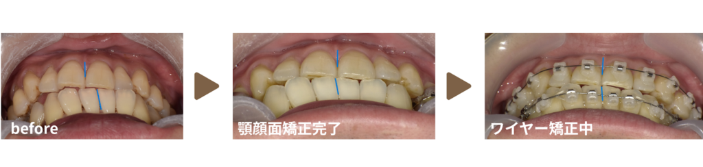 矯正治療を受けた30代男性の治療経過の写真