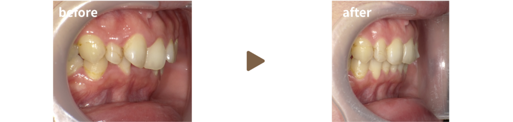 インビザラインにて治療を受けた20代女性の治療前後の写真