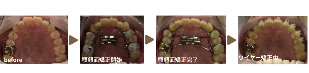 矯正治療を受けた30代男性の治療経過の写真