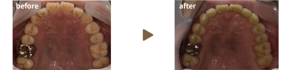 矯正治療を受けた30代男性の治療前後の写真