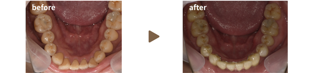 矯正治療を受けた30代男性の治療前後の写真