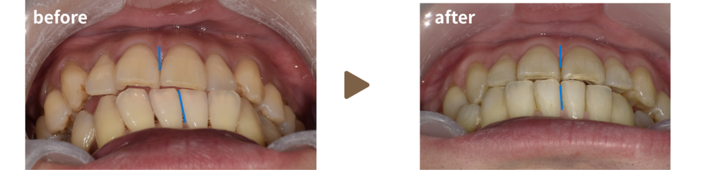 矯正治療を受けた30代男性の治療前後の写真