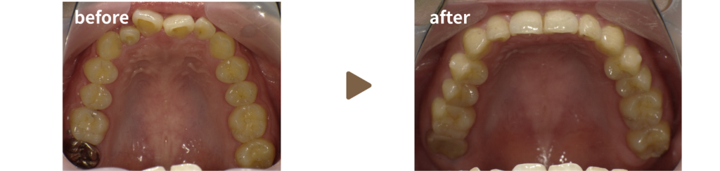 インビザラインにて治療を受けた20代女性の治療前後の写真