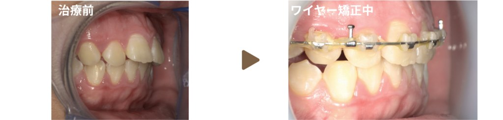 ワイヤー矯正を行った10代女性の治療前と矯正中の写真