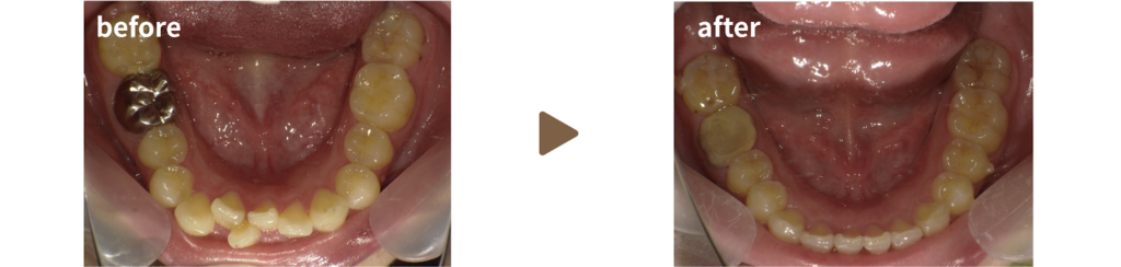 インビザラインにて治療を受けた20代女性の治療前後の写真