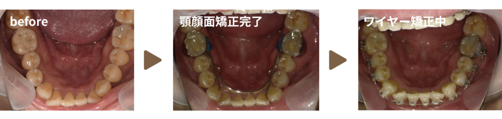 矯正治療を受けた30代男性の治療経過の写真