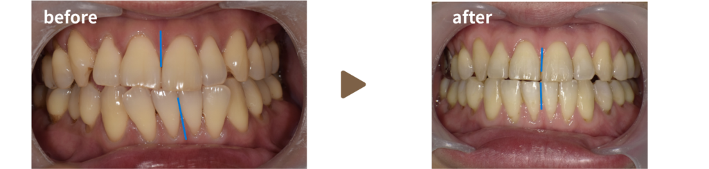 矯正治療を受けた30代男性の治療前後の写真