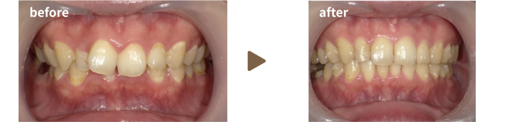 足利市歯科にてインビザラインにて治療を受けた20代女性の治療前後の写真
