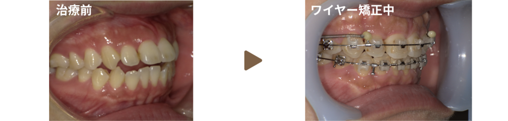 ワイヤー矯正を行った20代女性の治療前と矯正中の写真
