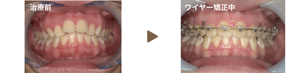 足利市の歯科にてワイヤー矯正を行った10代女性の治療前と矯正中の写真