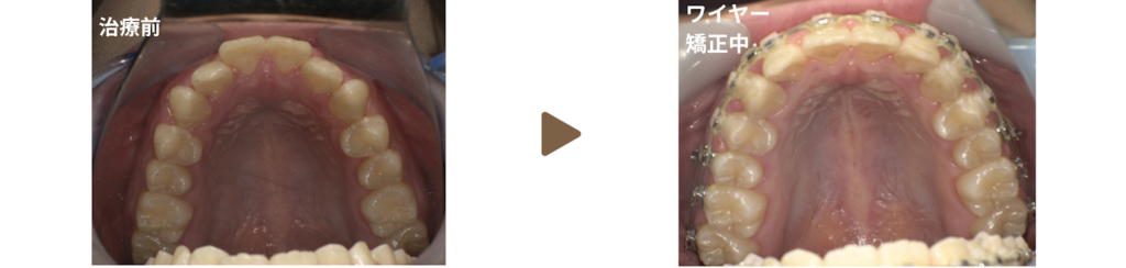 ワイヤー矯正を行った10代女性の治療前と矯正中の写真