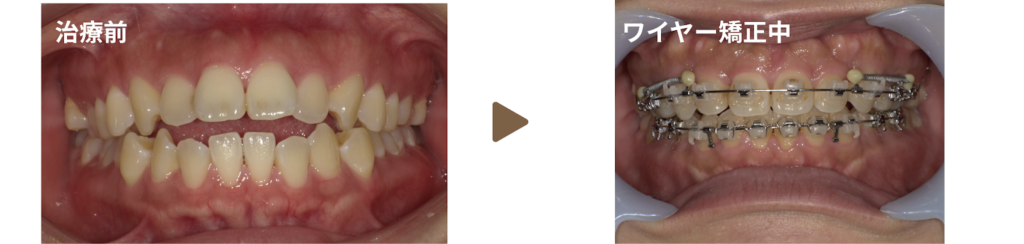 足利市の歯科にてワイヤー矯正を行った20代女性の治療前と矯正中の写真