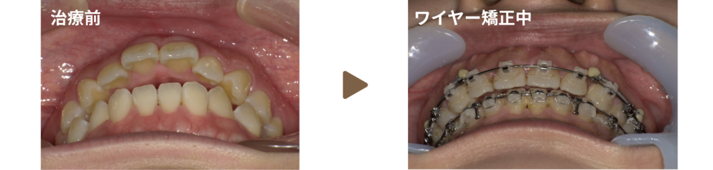ワイヤー矯正を行った20代女性の治療前と矯正中の写真