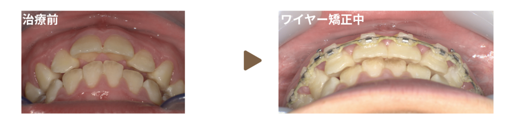 ワイヤー矯正を行った10代女性の治療前と矯正中の写真