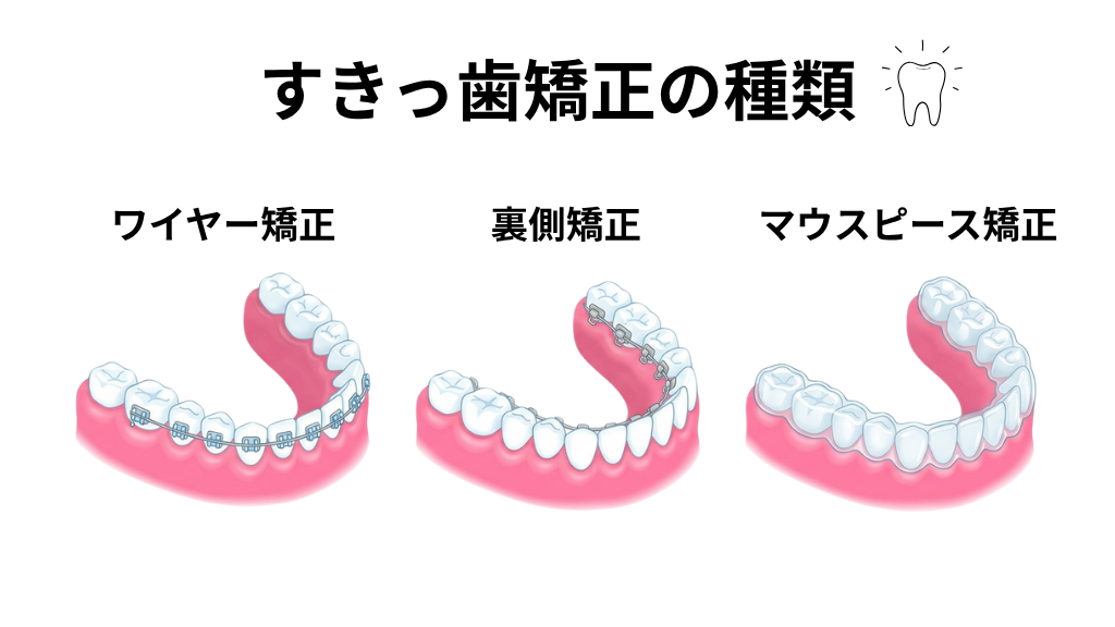 すきっ歯の矯正治療の種類を示す図解イラスト