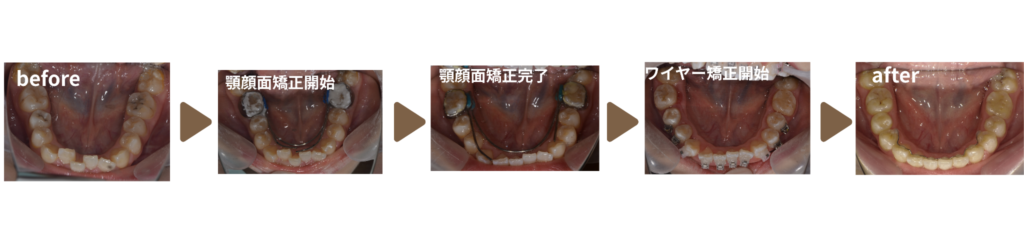 矯正治療を受けた女の子の治療前後の写真